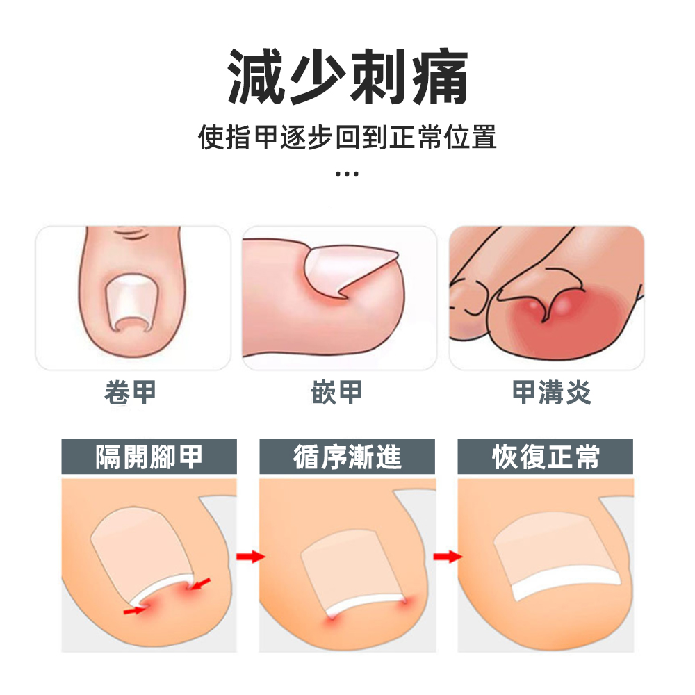 ingrown-toenail-correction-patch-40pcs, , large