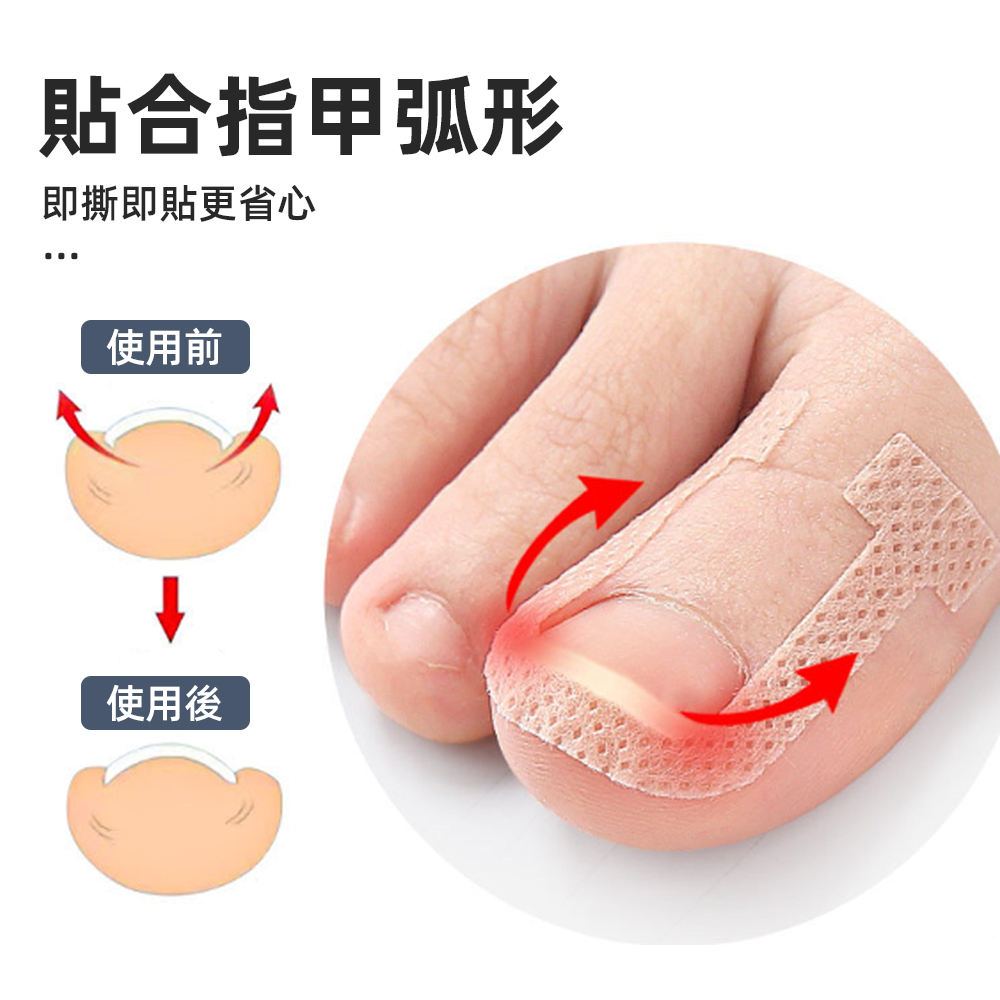 ingrown-toenail-correction-patch-40pcs, , large